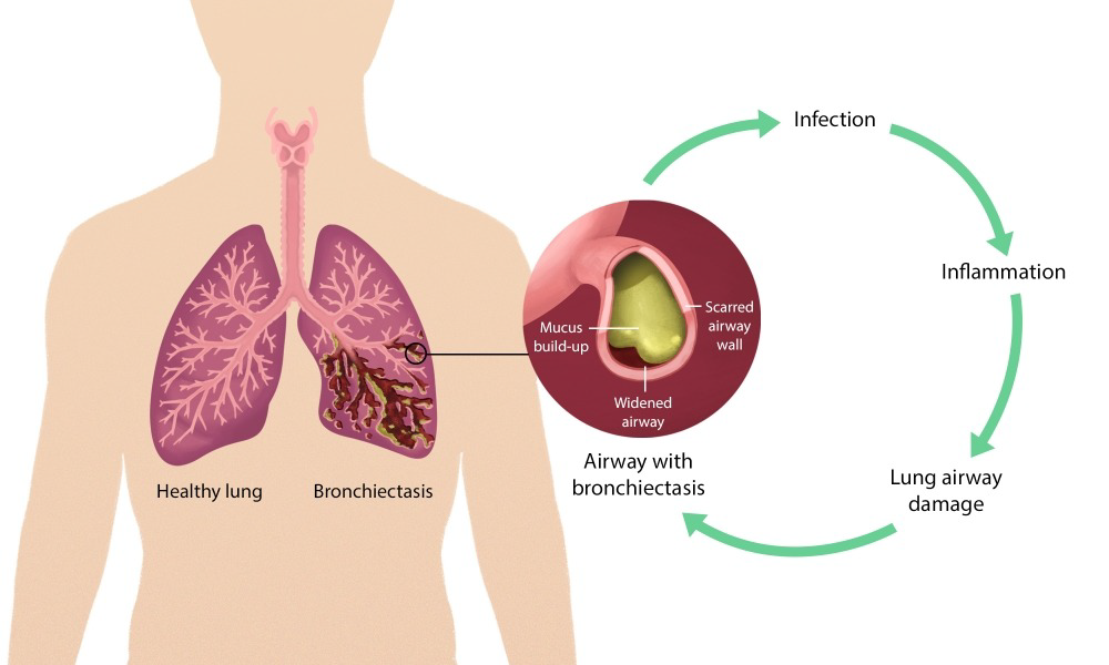 image of a healthy lung and a lung with bronchiectasis and a flow chart of infection to inflammation to lung airway damage to an airway with bronciectasis